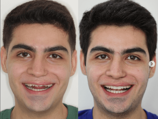 Antes — Harmonização orofacial
